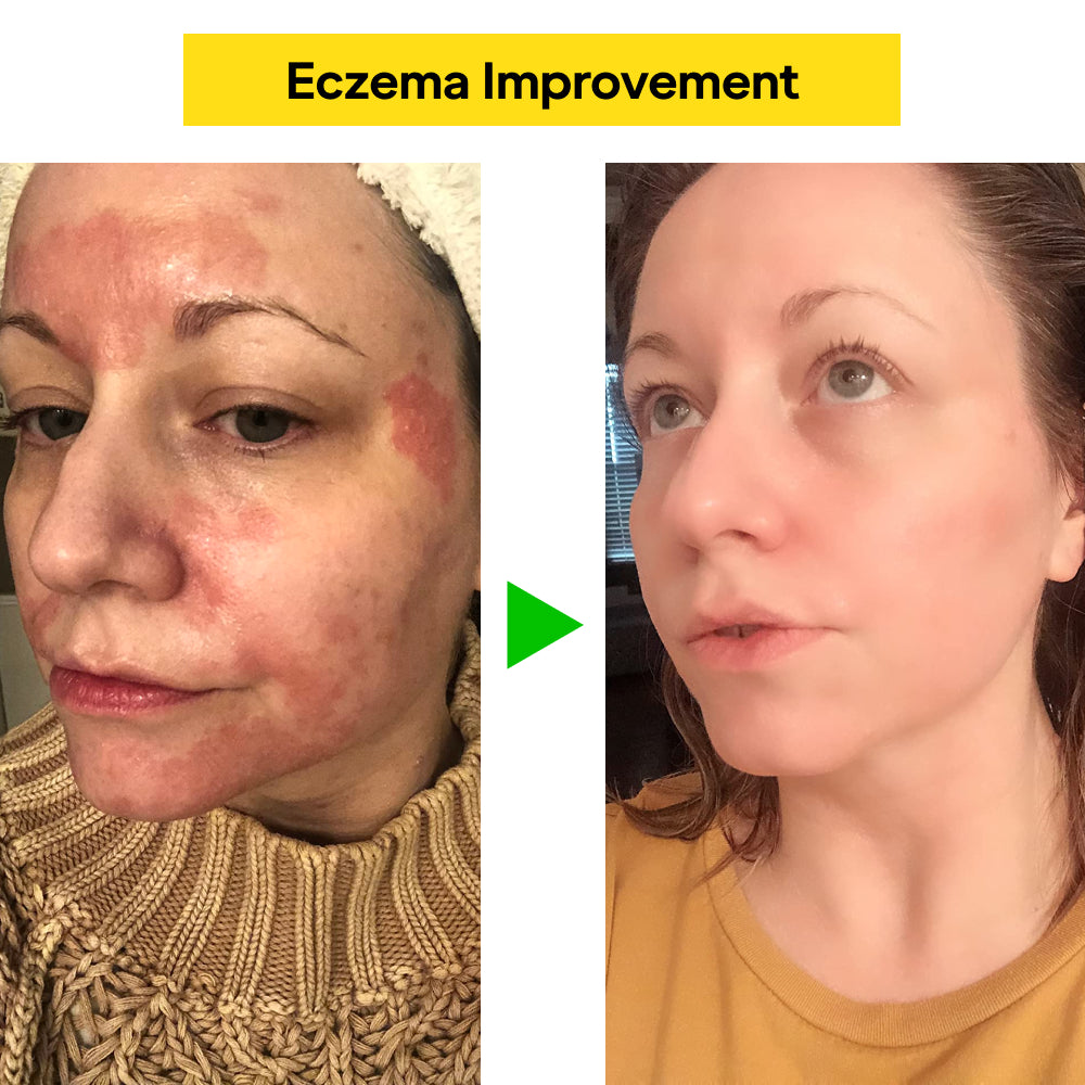 East Asia Eczema & Psoriasis Herbal Cream