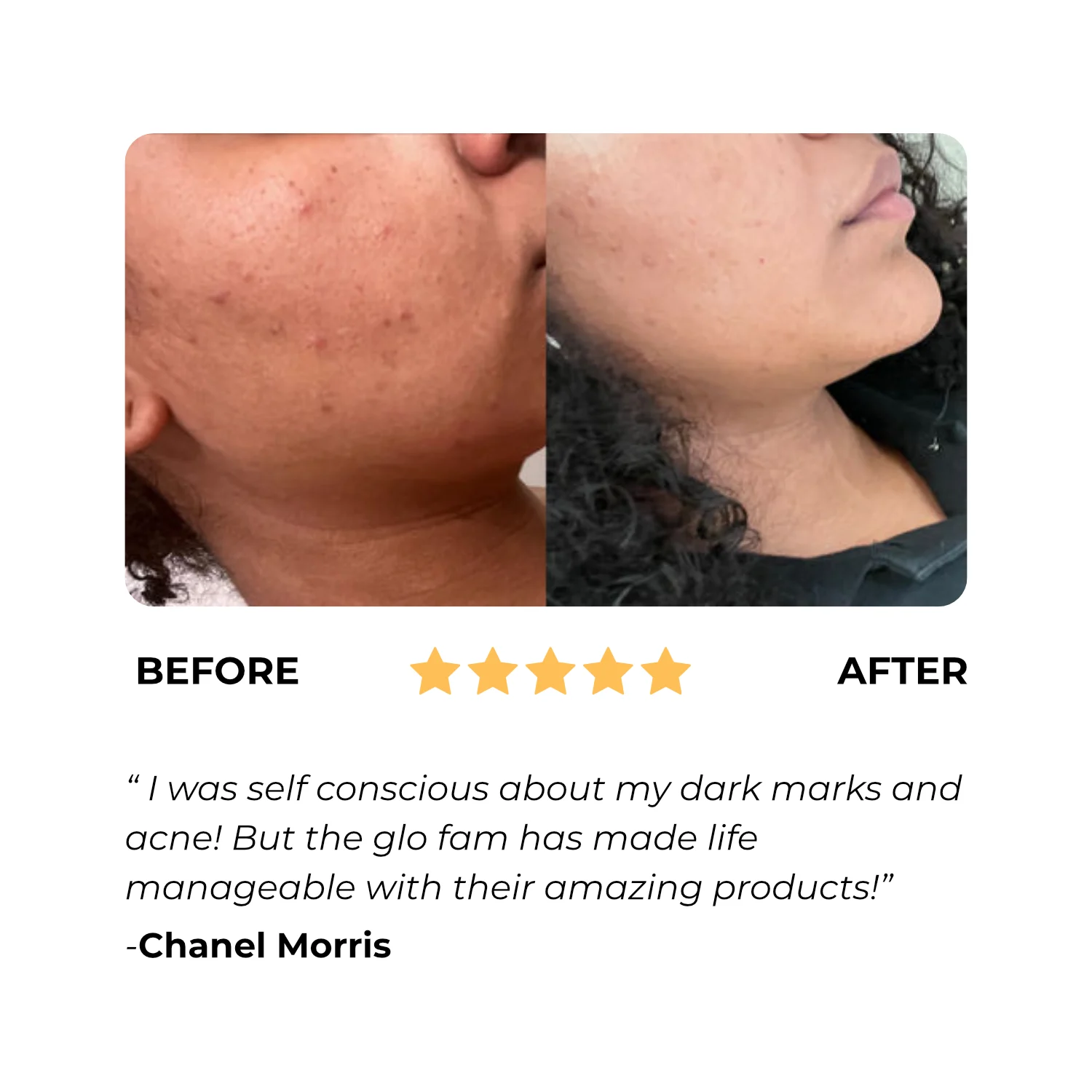 💖 Mother's Day discount 49% OFF-Lemon Turmeric and Kojic Acid Skin Brightening Soap(1 SETS 2 PCS 🔥BUY MORE SAVE MORE )