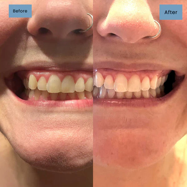 🦷 Niacinamide Whitening Toothpaste - For Healthier, Whiter Teeth!