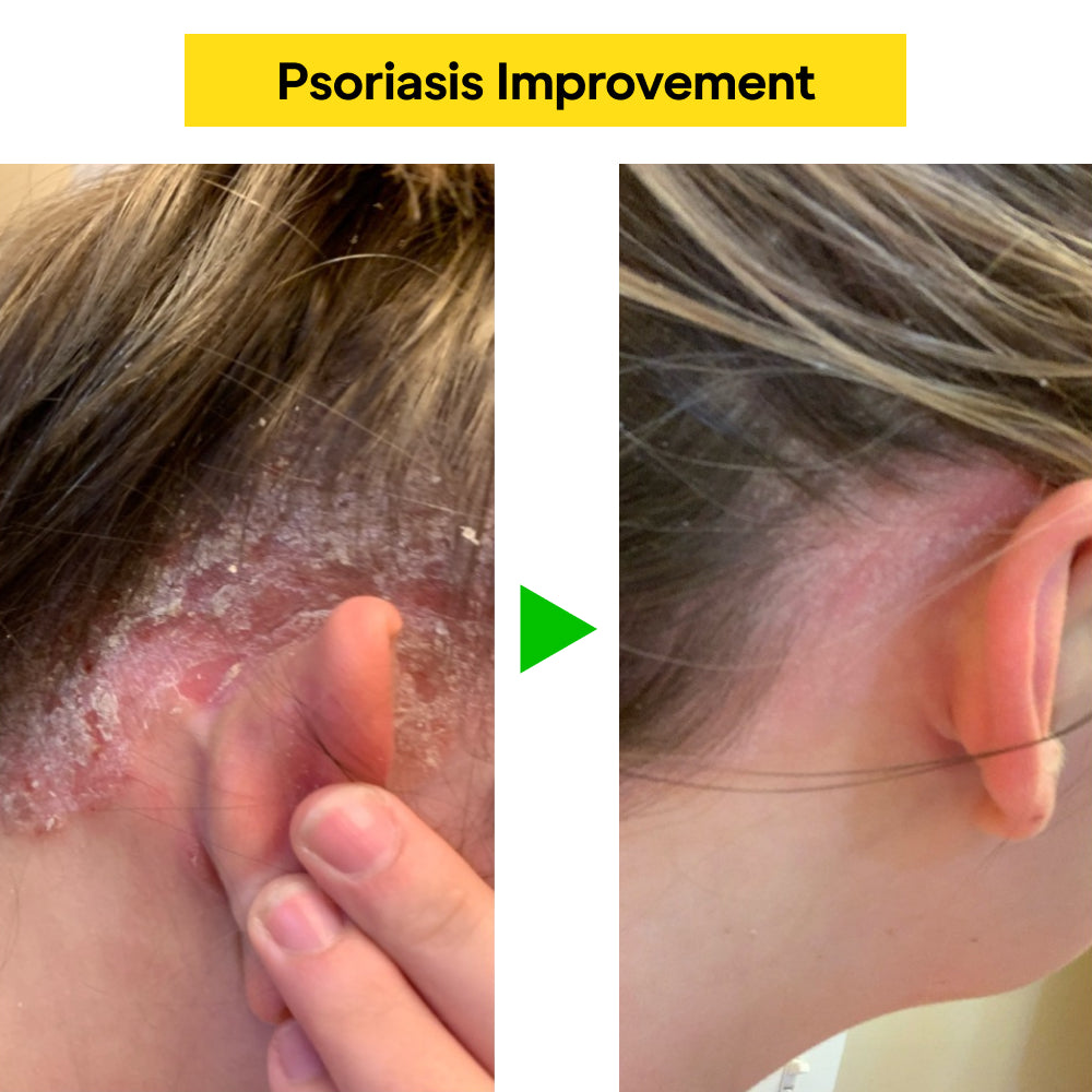East Asia Eczema & Psoriasis Herbal Cream
