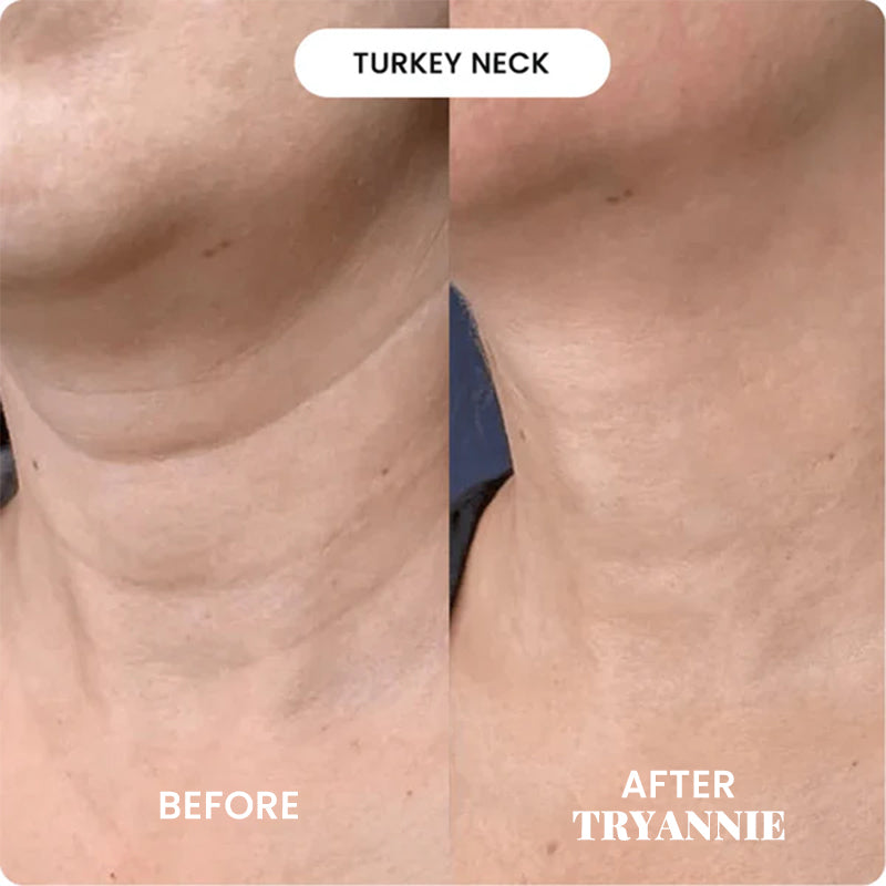 The Micro Infusion System