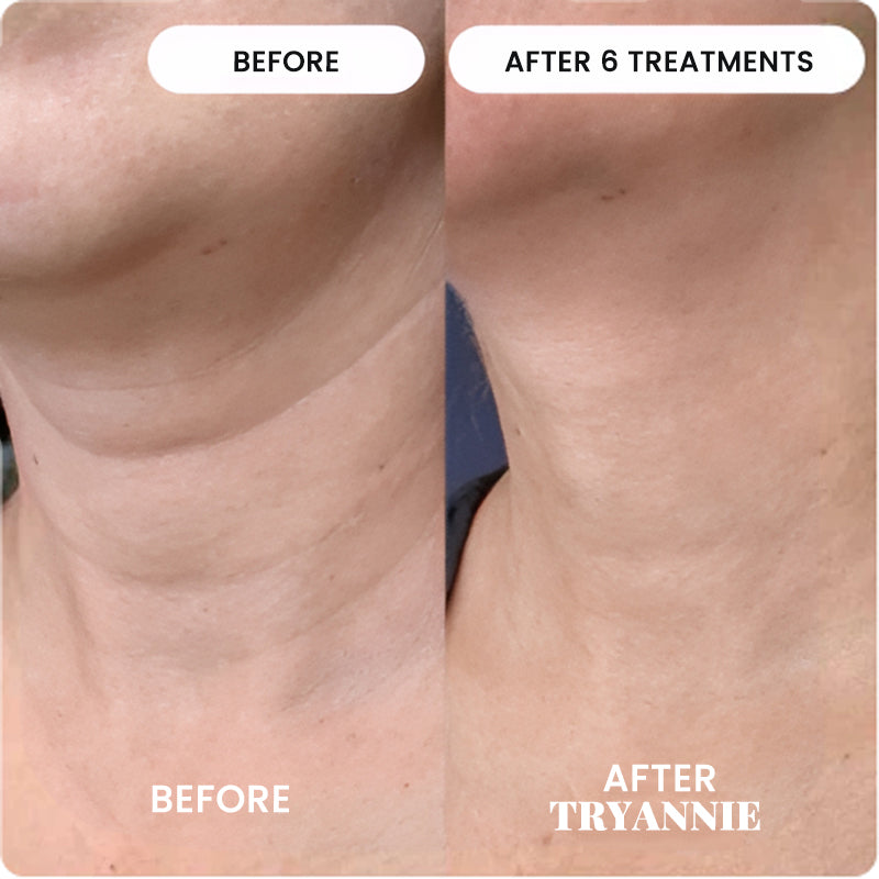 The Micro Infusion System