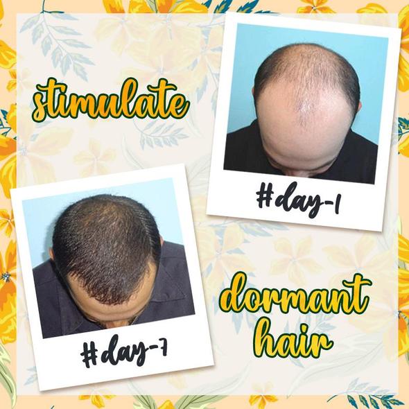 10X-Regro Strong Hair Serum - 💯BUY MORE SAVE MORE💯