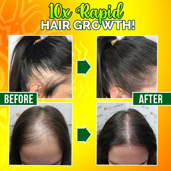 10X-Regro Strong Hair Serum - 💯BUY MORE SAVE MORE💯