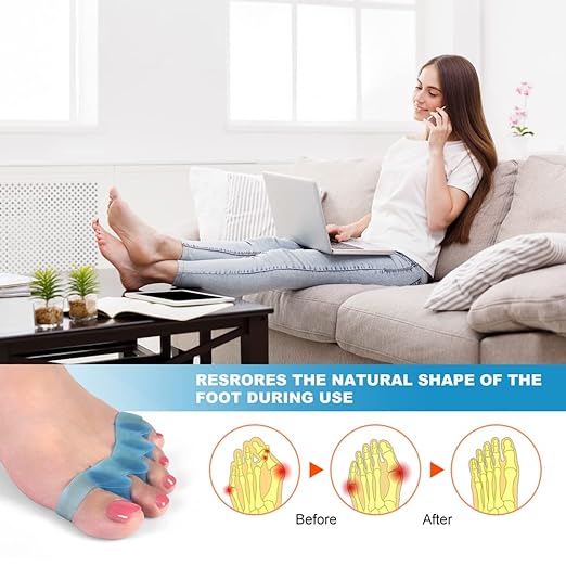 Correcting Bunions and Restoring Toes