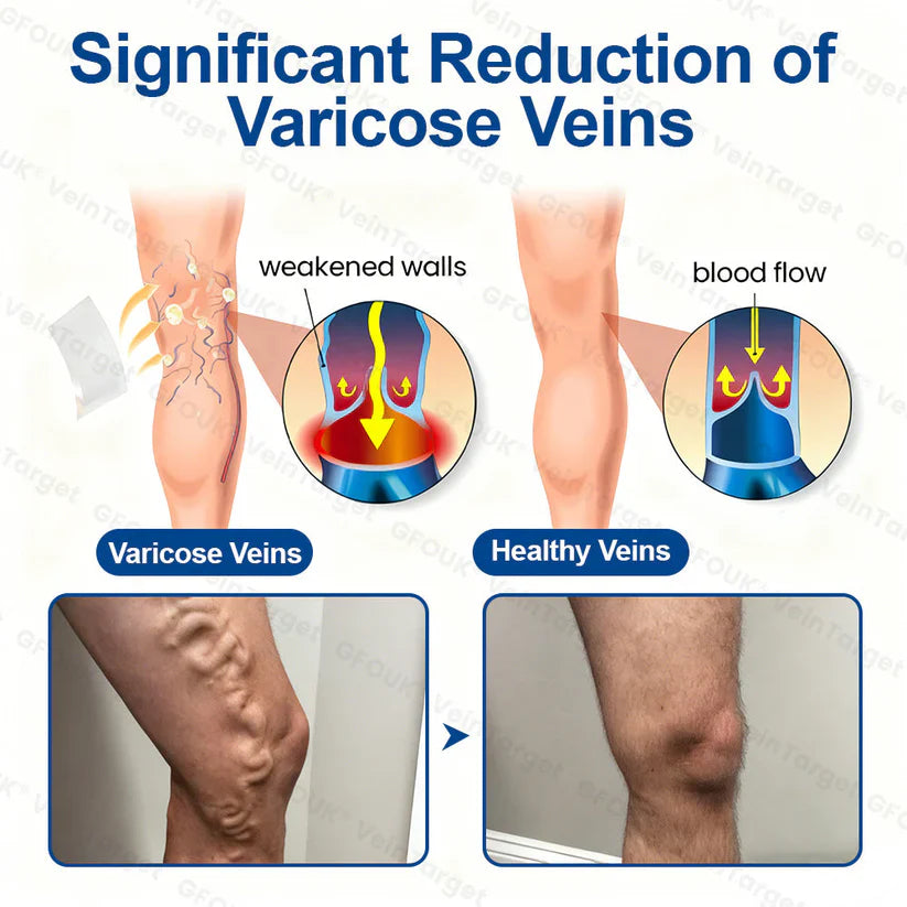 💧🧫GFOUK® VeinTarget Microneedle Patch⚡Instant Relief, Long-Term Results