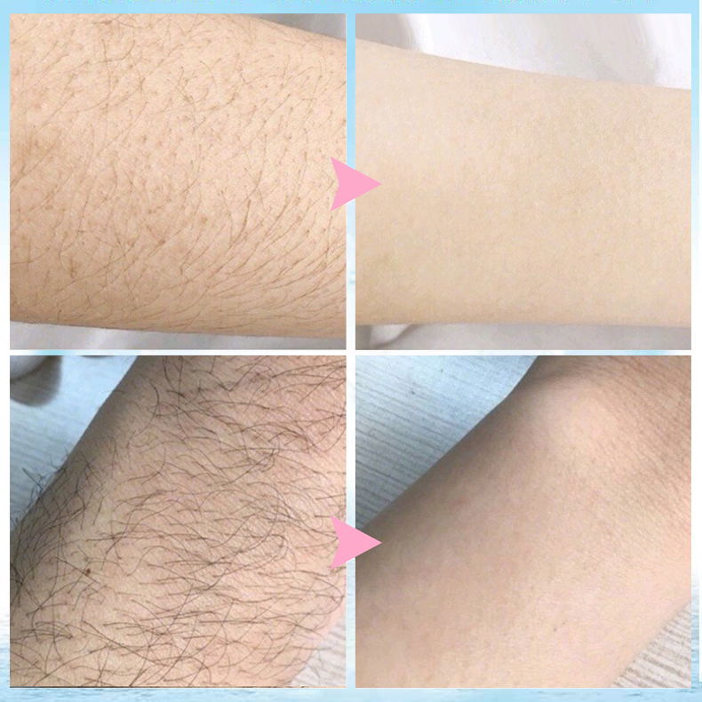 🔥 2023 Magic Hair Removal & Hair Inhibitor【Buy 5+ Get Extra 25% OFF】
